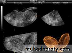 Ultrasonography in Gynaecology