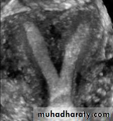 Ultrasonography in Gynaecology