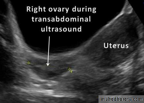 Ultrasonography in Gynaecology