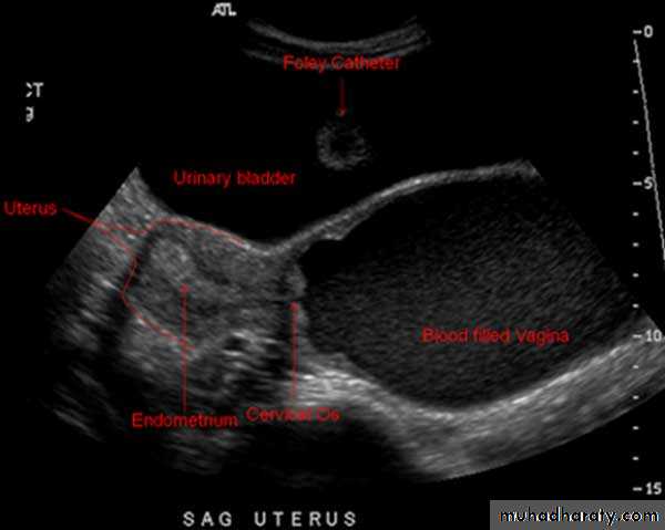 Ultrasonography in Gynaecology