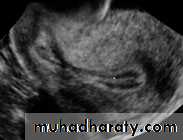 Ultrasonography in Gynaecology
