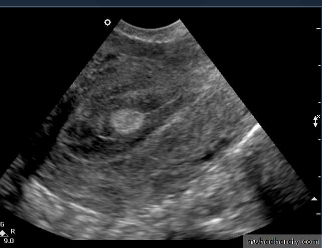 Ultrasonography in Gynaecology