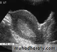 Ultrasonography in Gynaecology