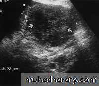 Ultrasonography in Gynaecology