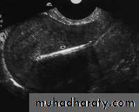 Ultrasonography in Gynaecology