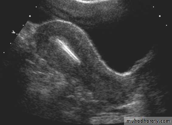 Ultrasonography in Gynaecology