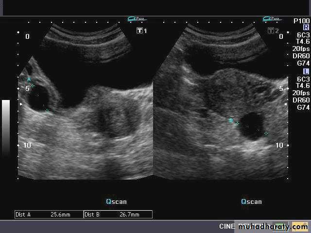 Ultrasonography in Gynaecology