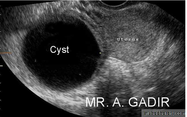 Ultrasonography in Gynaecology