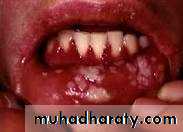 Infectious Diseases