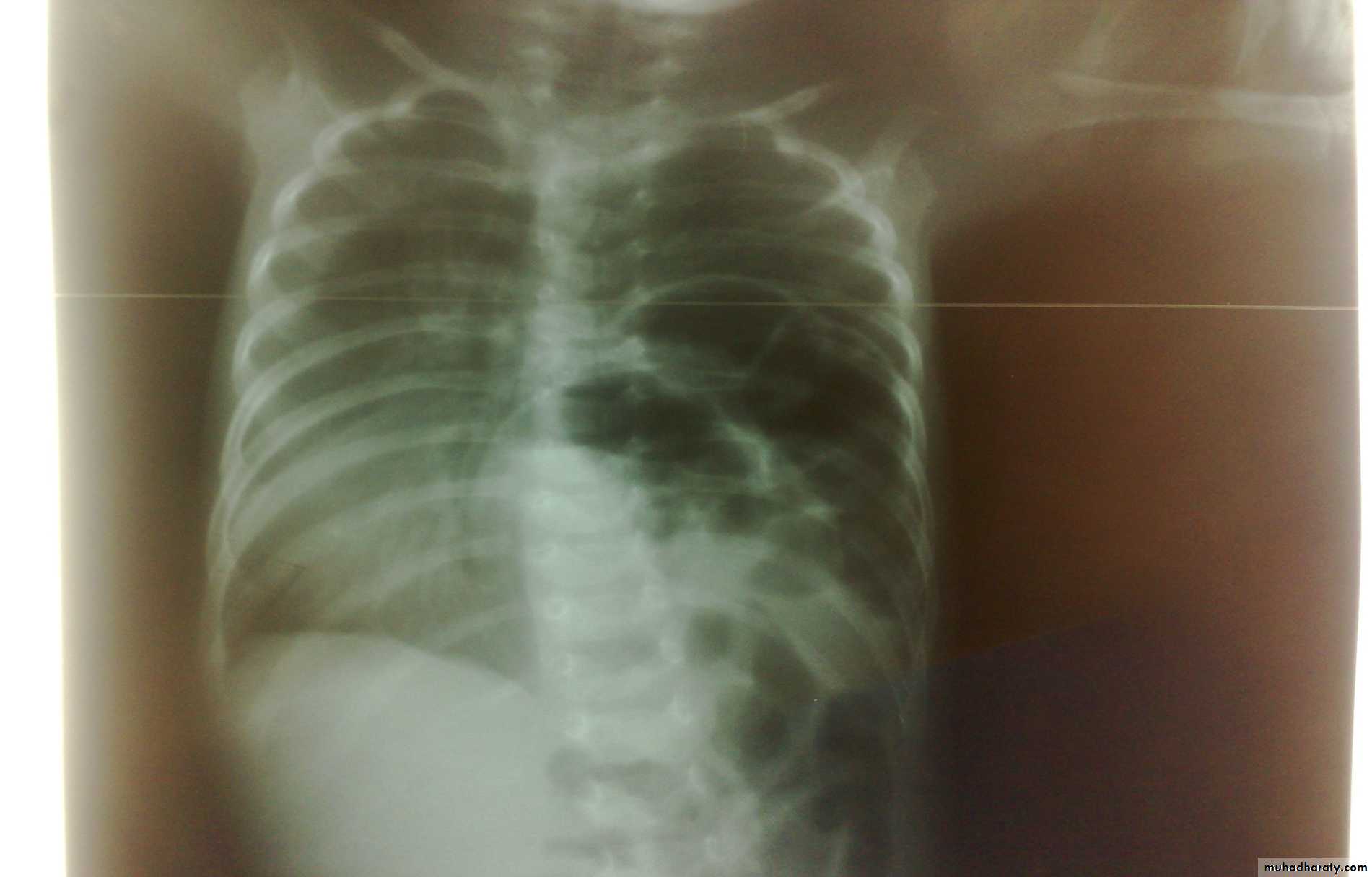 Pediatric surgery
