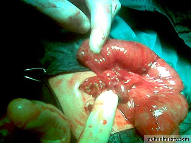 Pediatric surgery