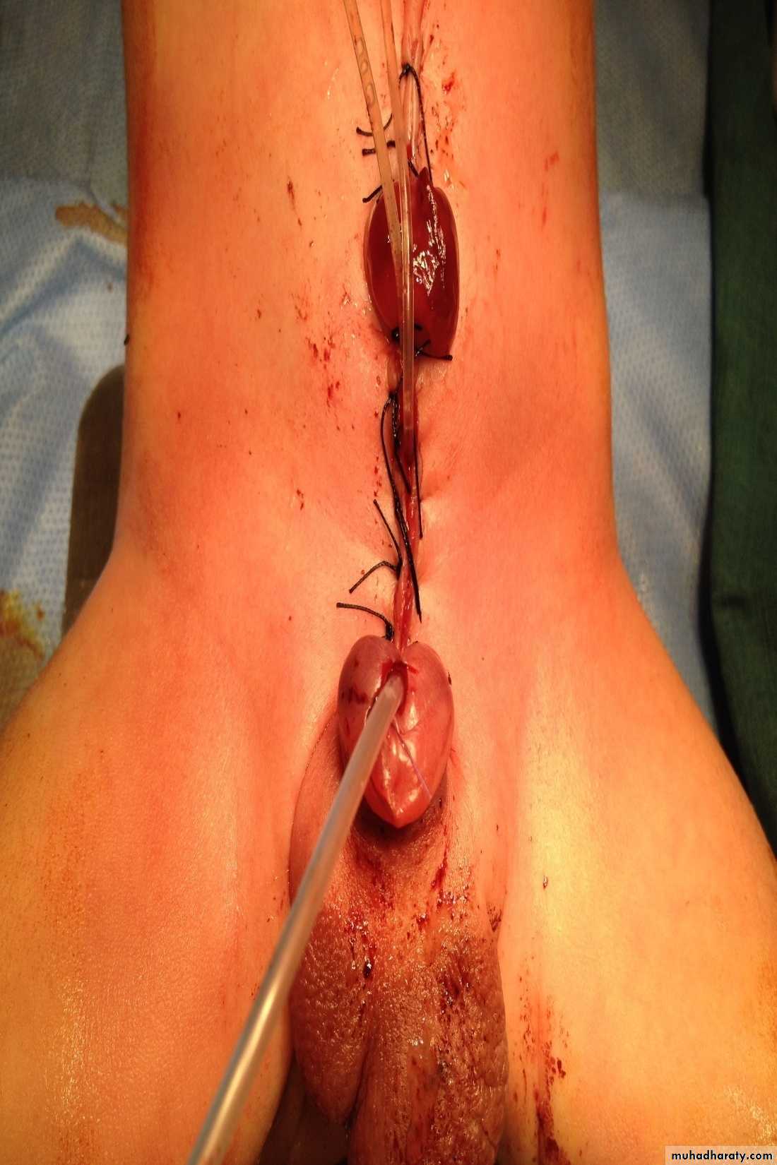 Pediatric surgery