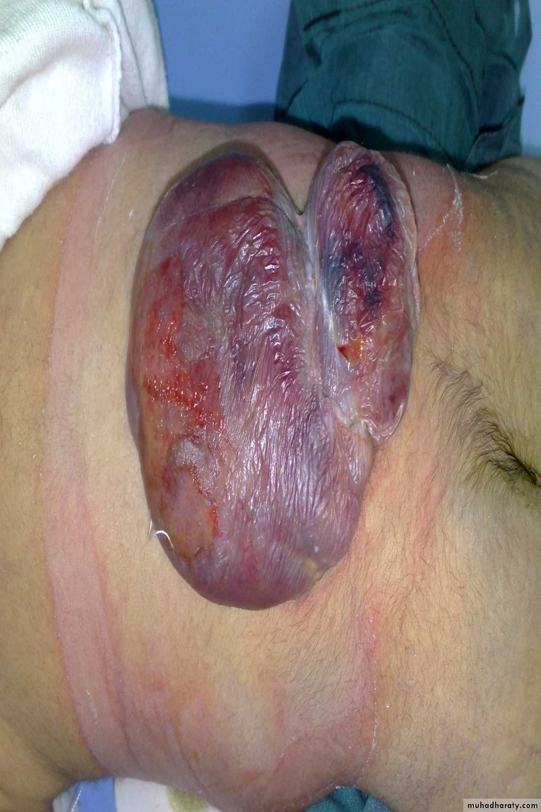 Pediatric surgery