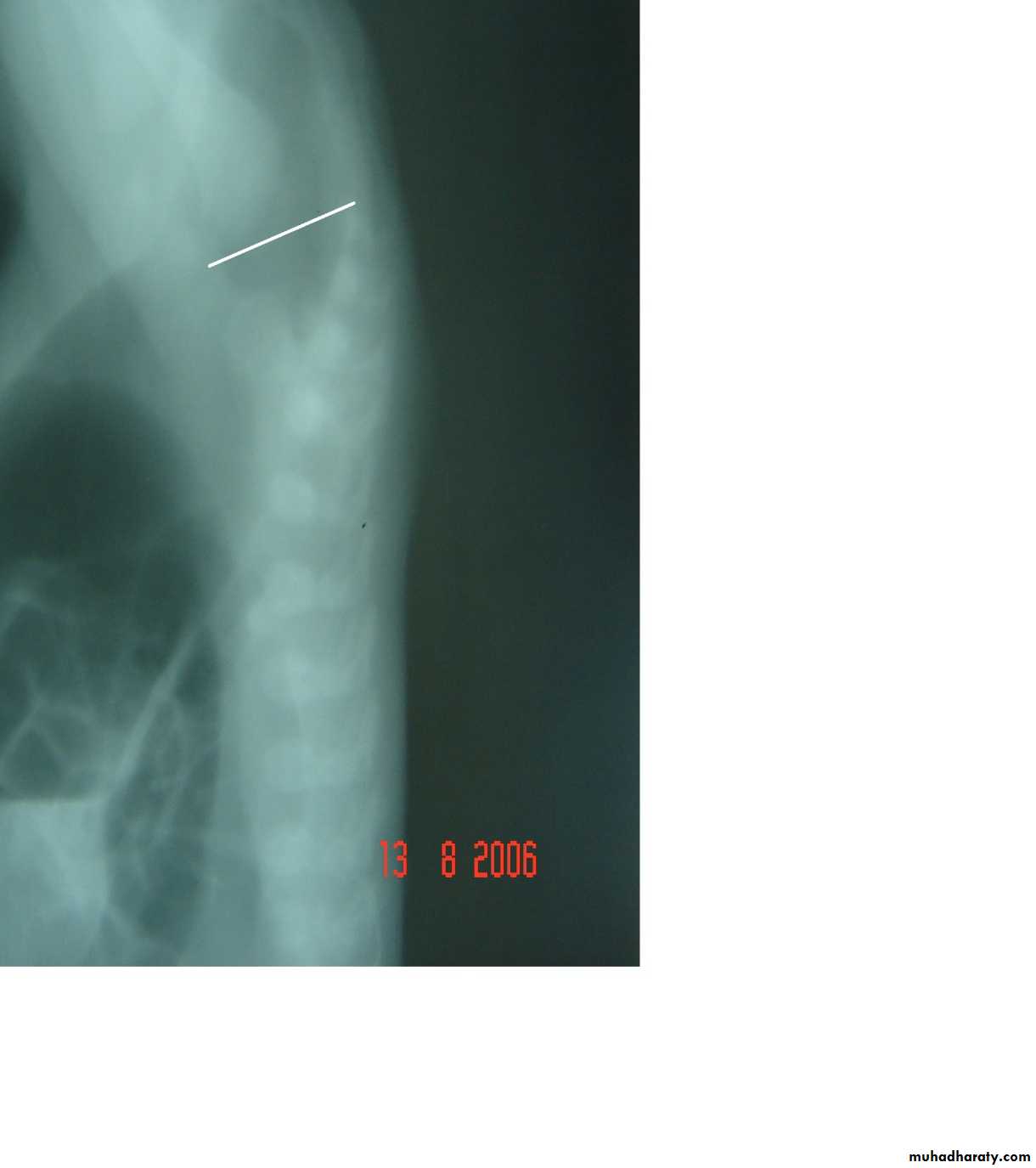 Pediatric surgery