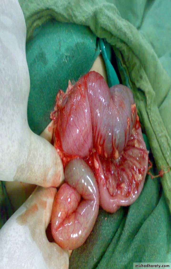 Pediatric surgery