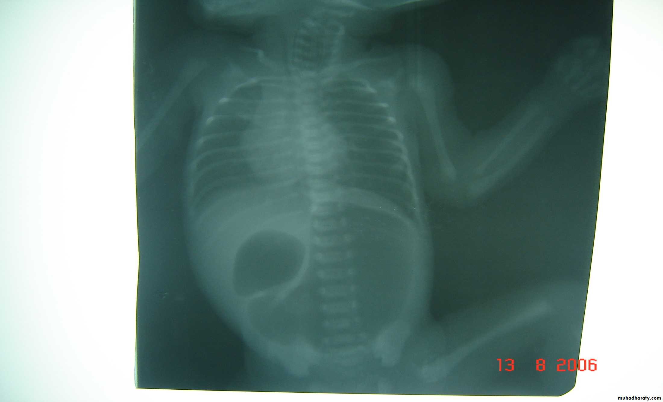 Pediatric surgery