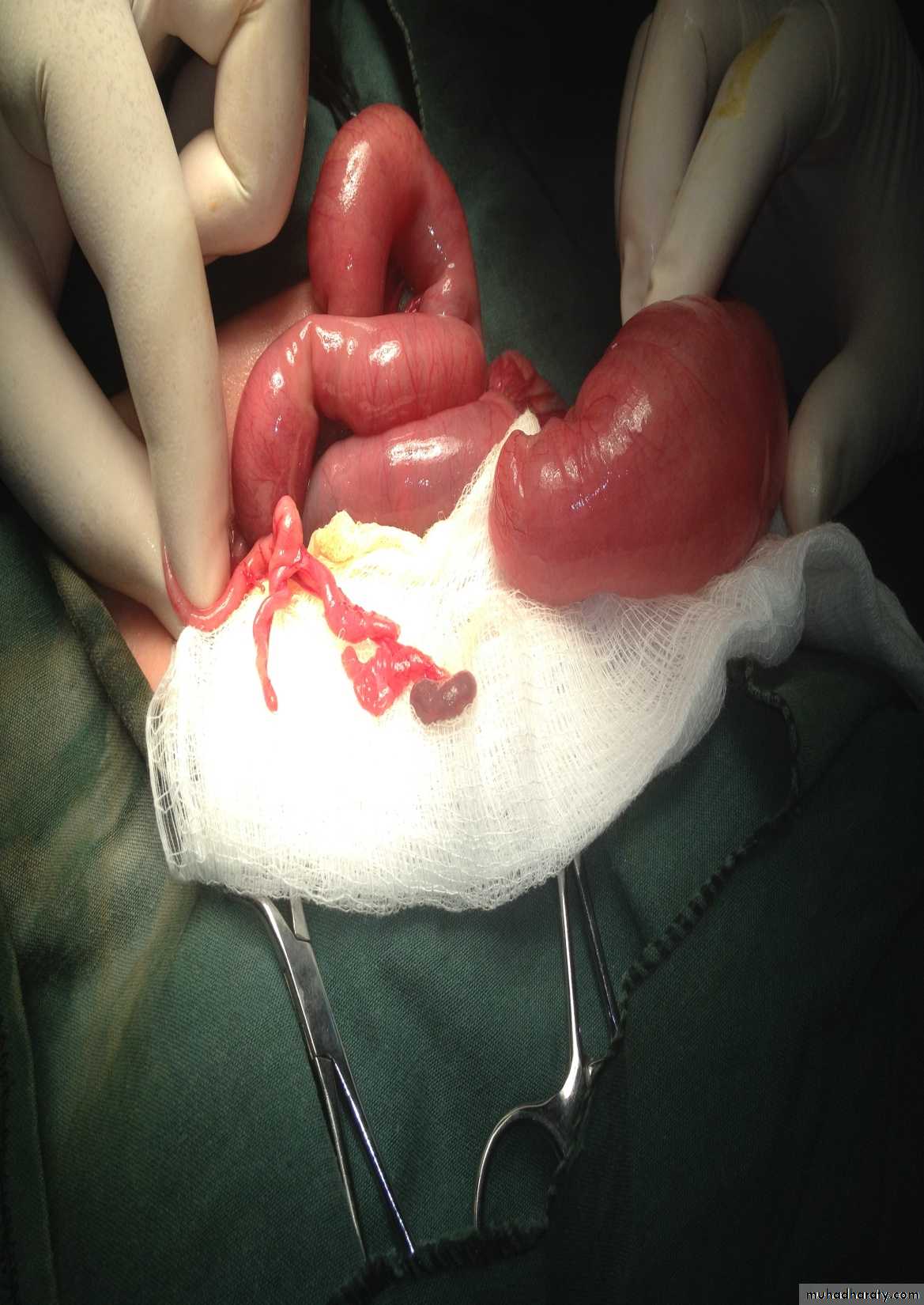 Pediatric surgery