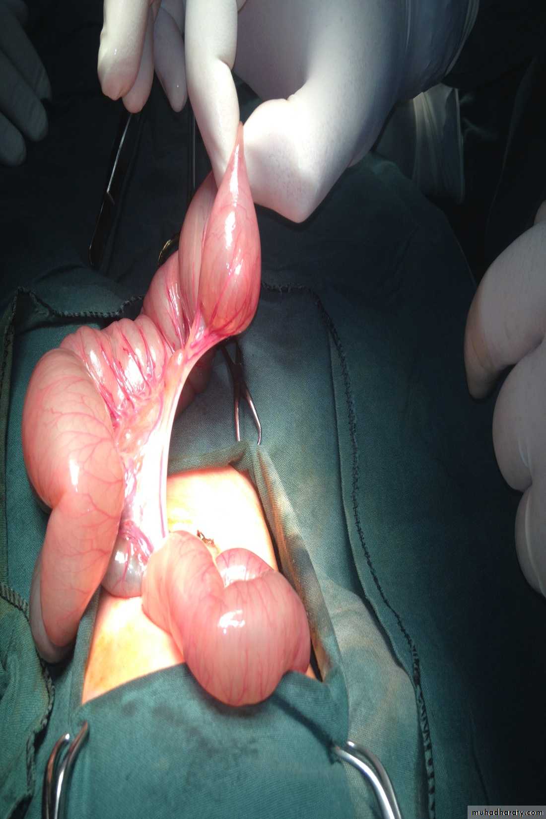 Pediatric surgery