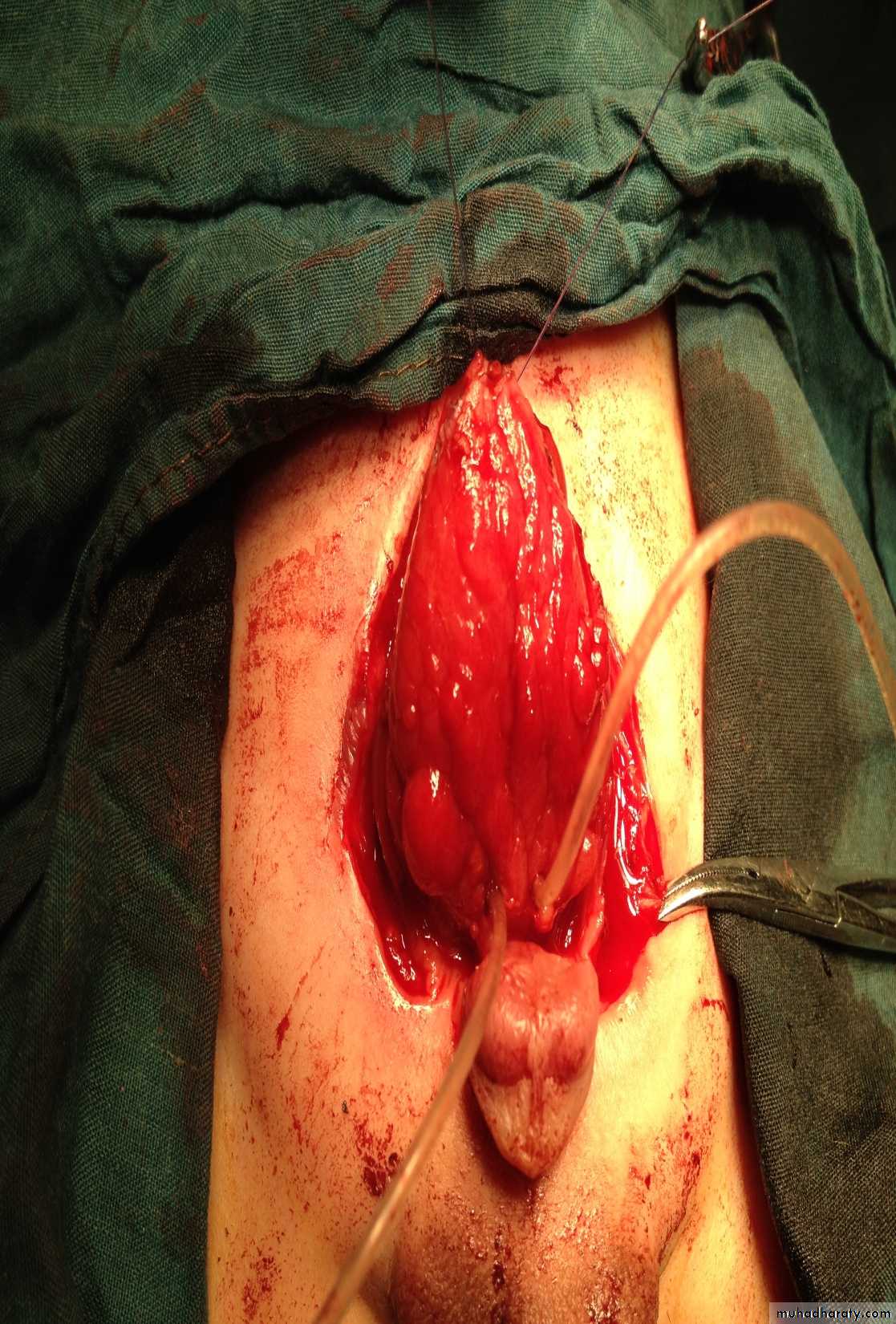 Pediatric surgery