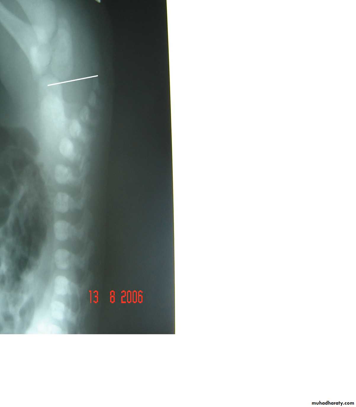 Pediatric surgery