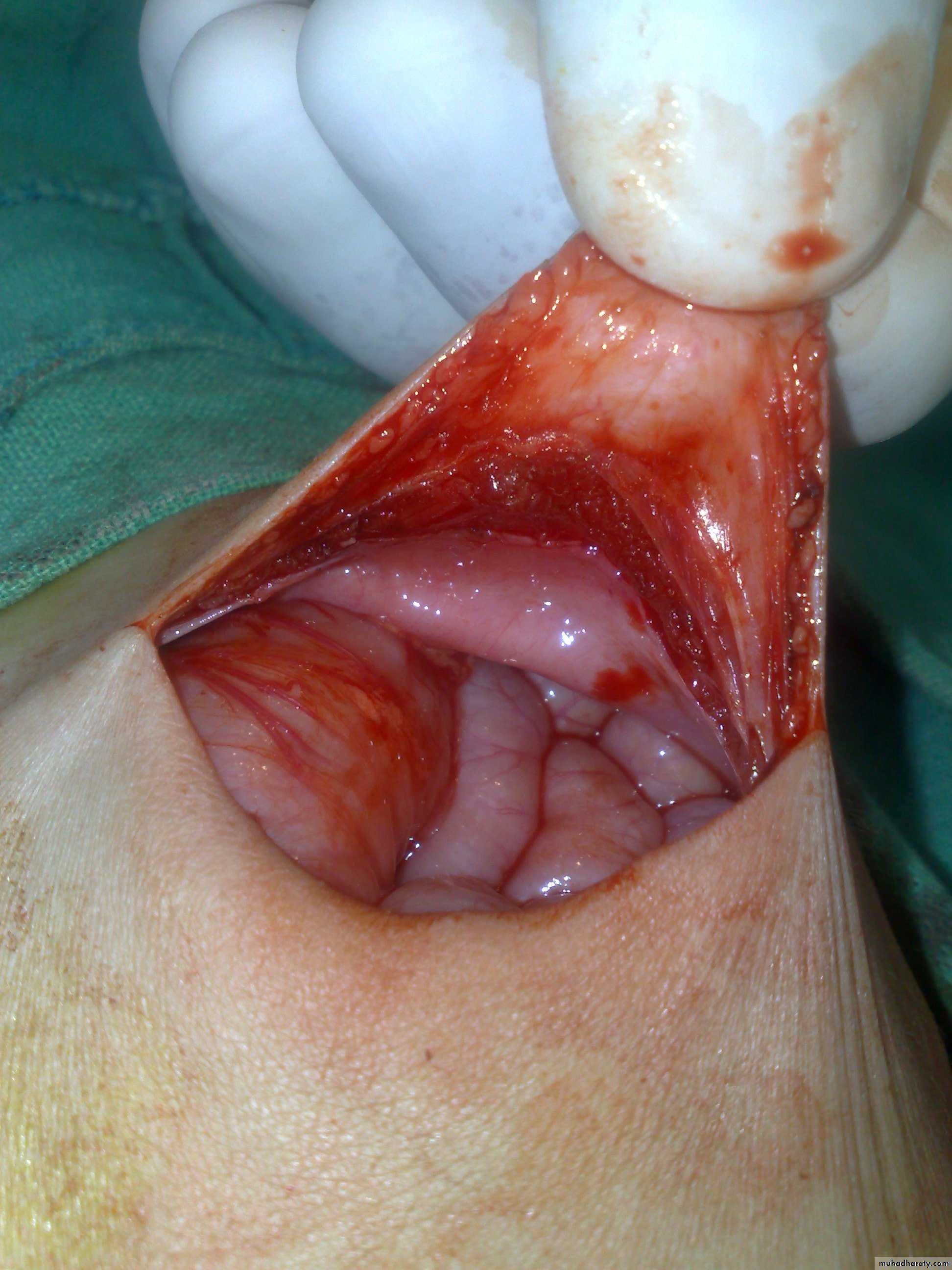 Pediatric surgery