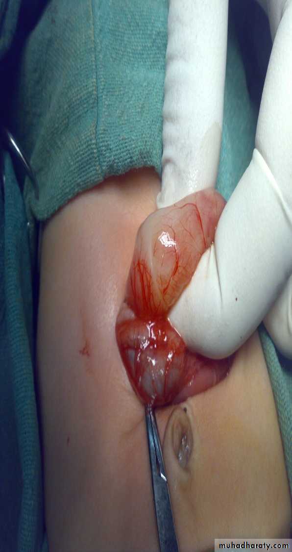 Pediatric surgery