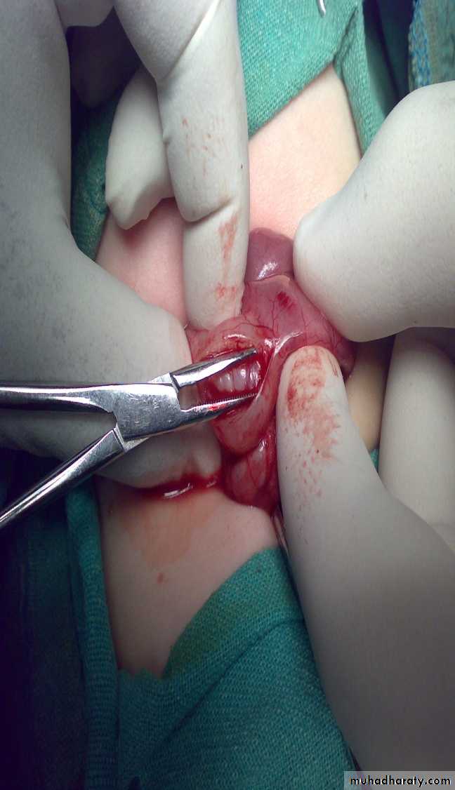 Pediatric surgery
