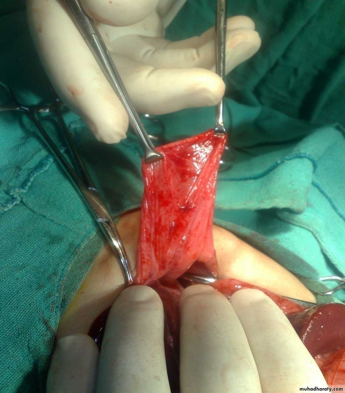 Pediatric surgery