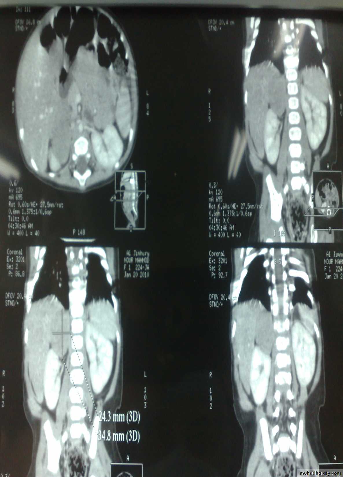 Pediatric surgery