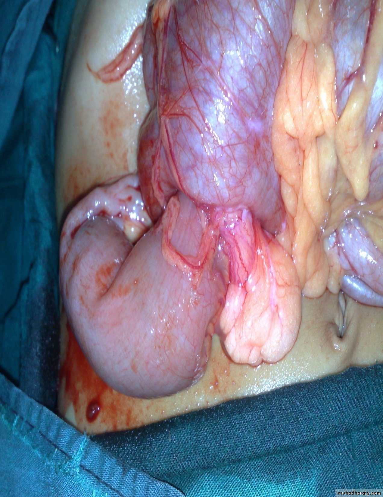 Pediatric surgery