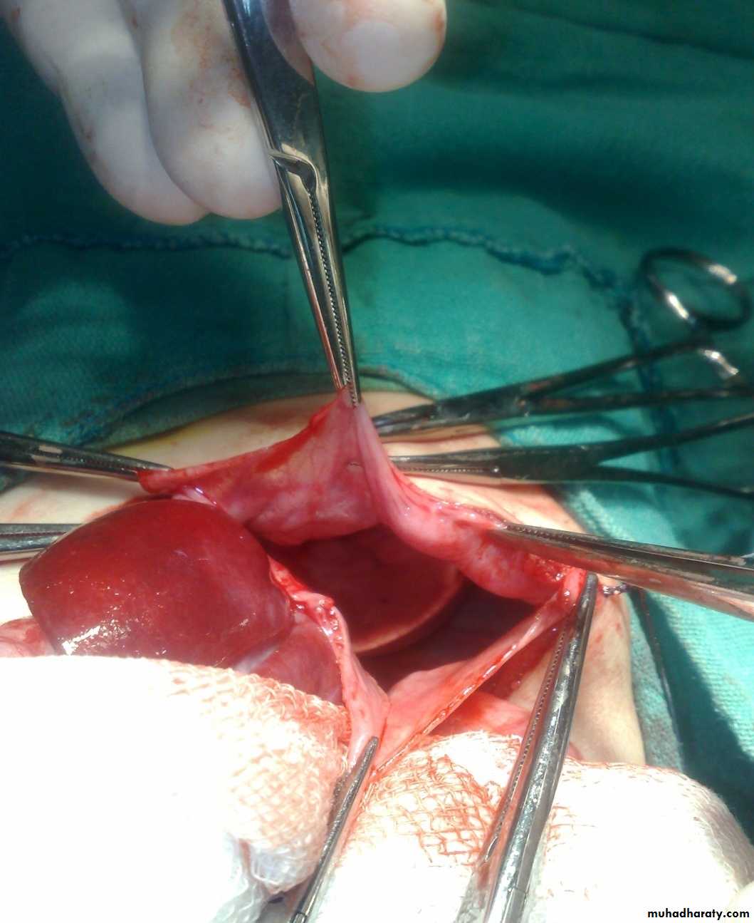 Pediatric surgery