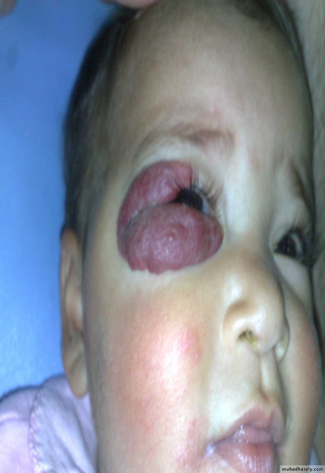 Pediatric surgery