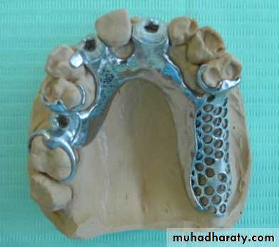 Metallic Denture Base
