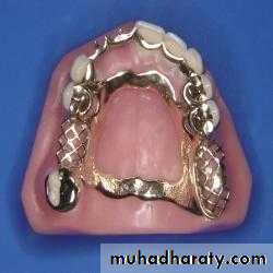 Metallic Denture Base