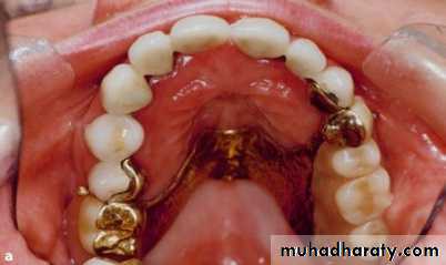 Metallic Denture Base