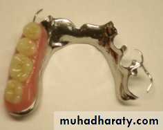 Metallic Denture Base