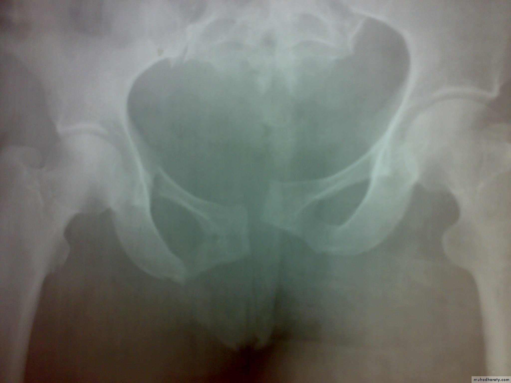 pelvis