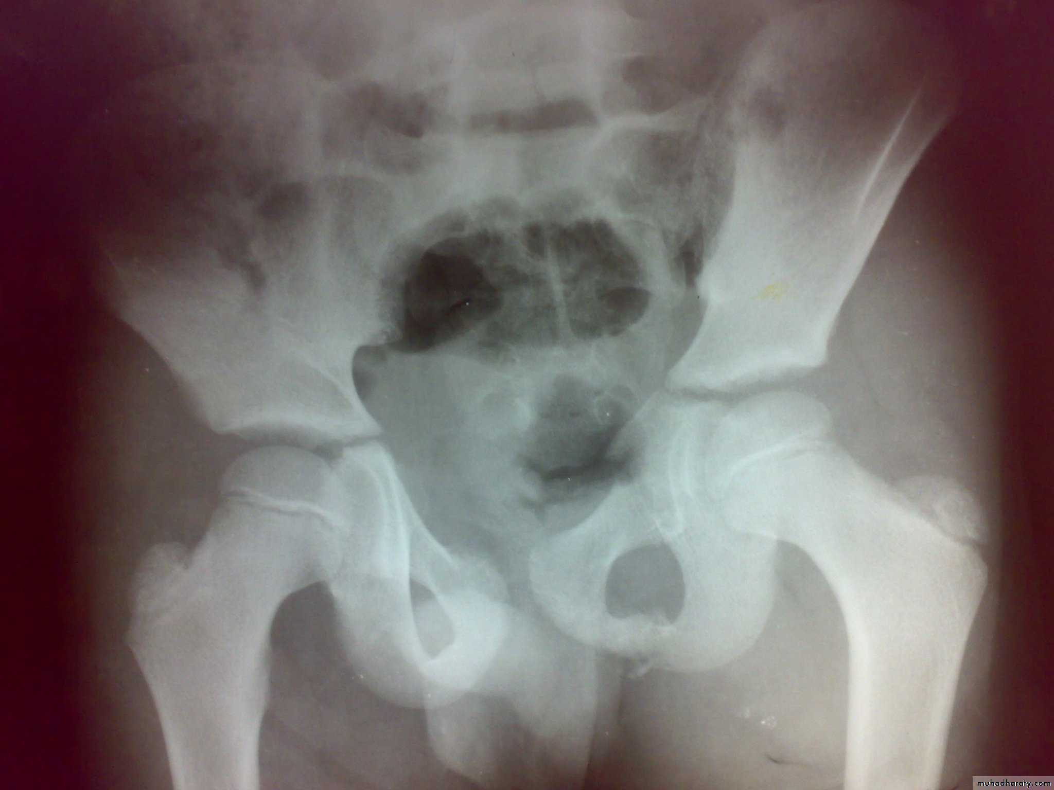 pelvis