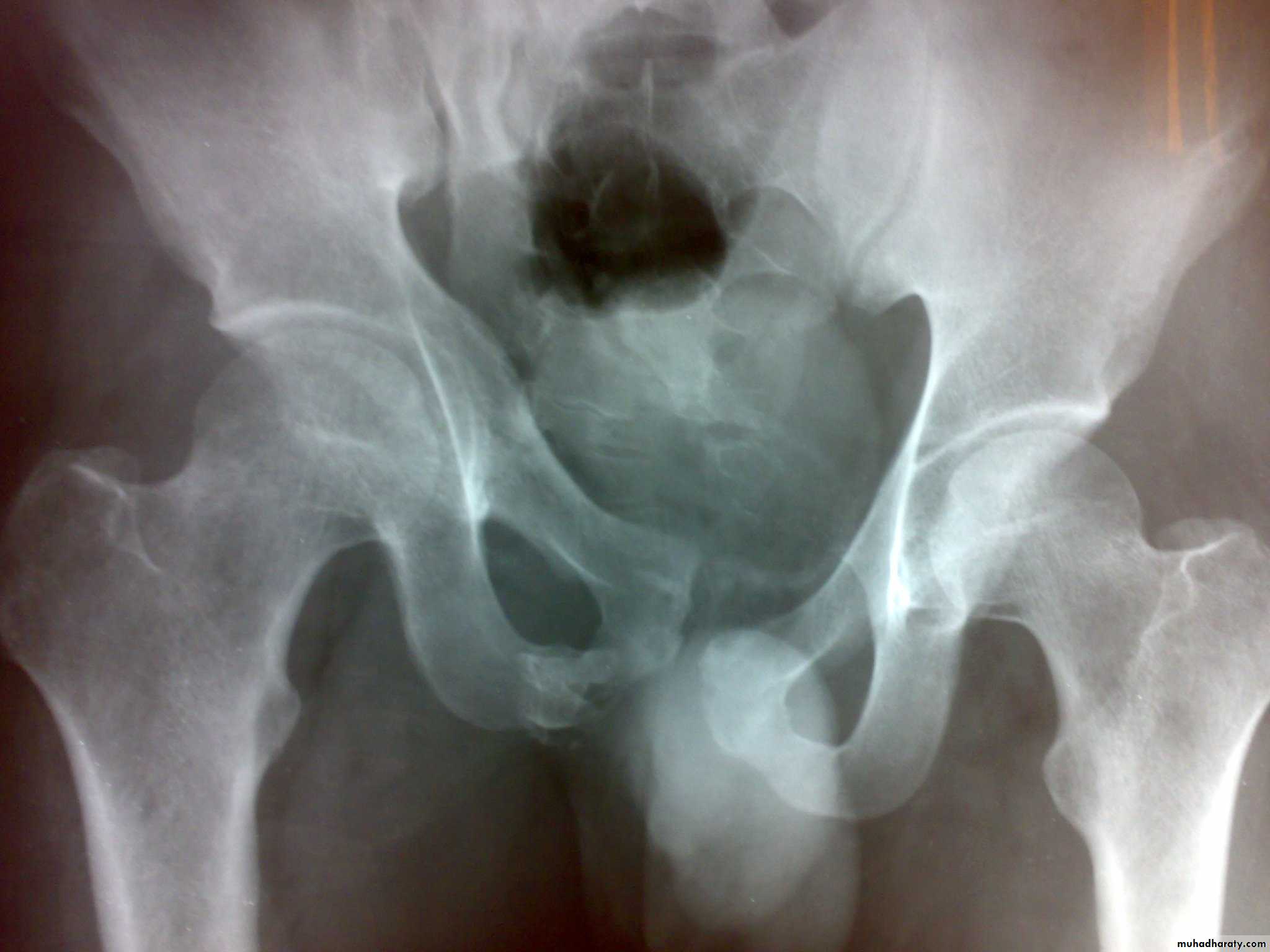 pelvis