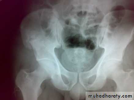 pelvis