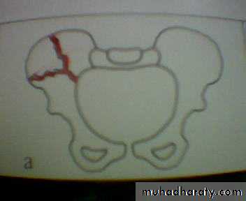 pelvis