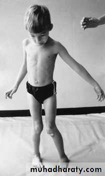 CEREBRAL PALSY