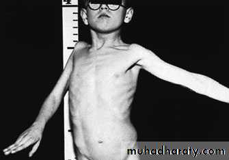CEREBRAL PALSY