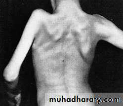 CEREBRAL PALSY