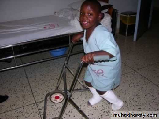 CEREBRAL PALSY
