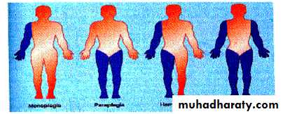 CEREBRAL PALSY