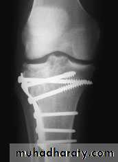 Lower limb
