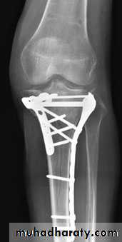 Lower limb