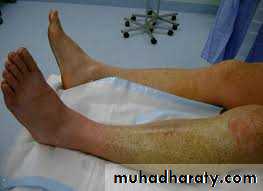 Lower limb