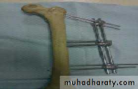 Lower limb